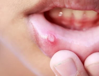 Τι να κάνετε για τις άφθες στο στόμα – Γιατί εμφανίζονται εξαρχής (βίντεο)